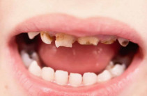 Ի՞նչ հիվանդությունների կարող են հանգեցնել չբուժված ատամները