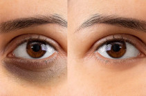 Աչքերի մուգ շրջանակներ. Առաջացման պատճառներն ու խնդրի վերացման ուղիները