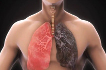 Թոքերի քրոնիկ օբստրուկտիվ հիվանդություն․ Ախտանշաններ և ռիսկի գործոններ