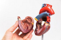 Միջնախասրտային միջնապատի կառուցվածքային խանգարում․ հայտնաբերվում է միայն սրտի ՈՒՁՀ-ի ժամանակ