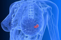 Կրծքագեղձի քաղցկեղ. զարգացման շրջանը և փուլերը