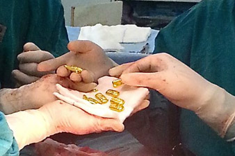 Indian surgeons find 12 gold bars in man's stomach