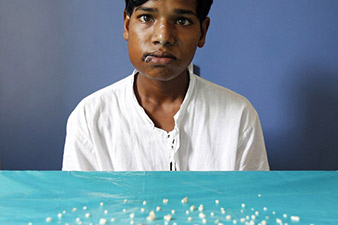 Indian teen has 232 teeth removed from mouth