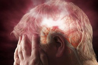Հայաստանում տարեկան արձանագրվում է ուղեղի անոթային հիվանդության 5000 դեպք
