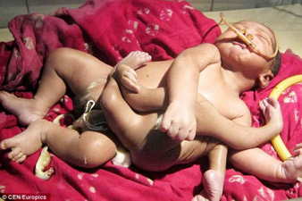 Հնդկաստանում ծնված 4 ոտքերով և 4 ձեռքերով երեխային «Աստծո որդի» են կոչում