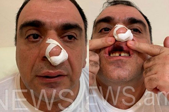 Մոսկվաբնակ գործարարը պնդում է, որ Երևանում Խաչատուր Սուքիասյանի եղբայրն ու թիկնապահն իրեն ծեծի են ենթարկել . News.am