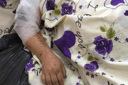 Արցախի ՄԻՊ-ն այցելել է ադրբեջանական ագրեսիայի հետևանքով վիրավորված քաղաքացիական անձանց