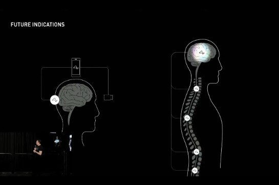 Իլոն Մասկի Neuralink-ը թույլտվություն է ստացել չիպավորելու մարդկանց ուղեղը